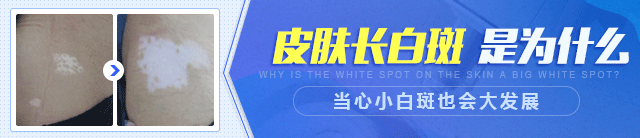 泉州中科白癜风医院白斑治疗