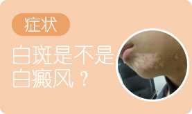 泉州中科白癜风医院白癜风症状