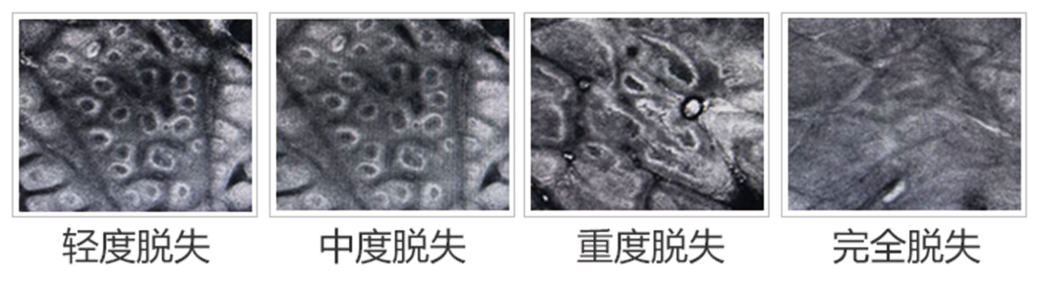 色素细胞在CT下的影像表现