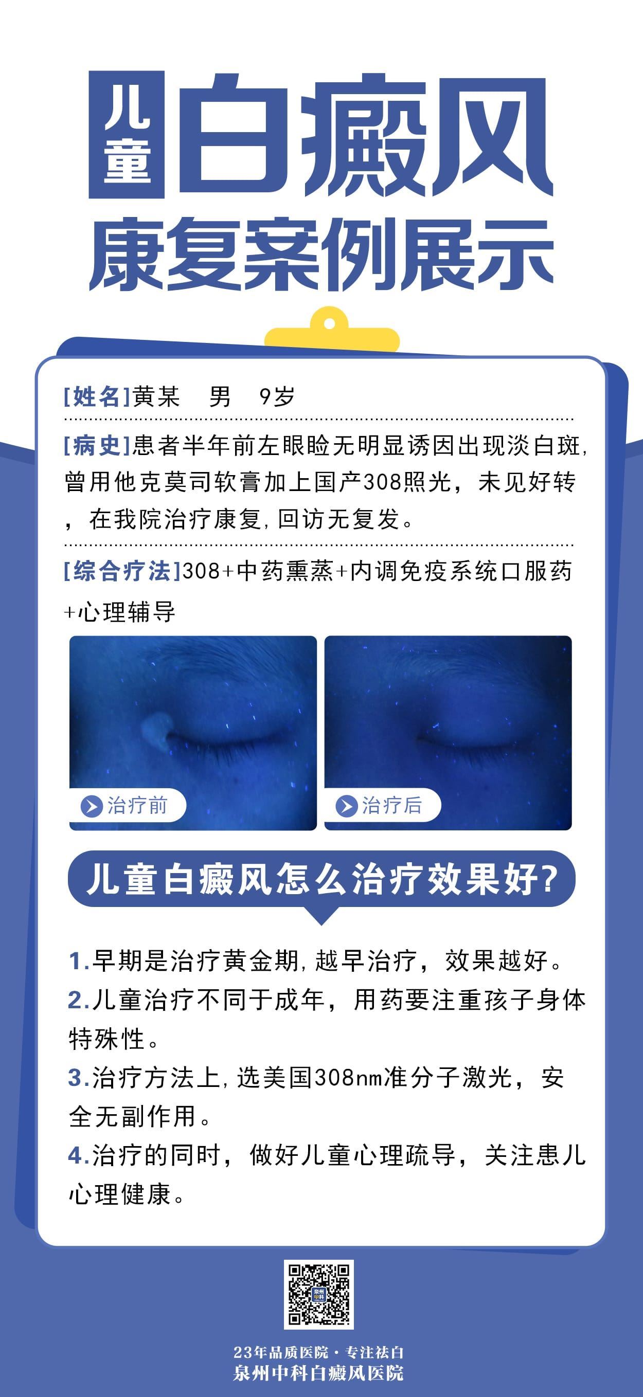儿童眼周白癜风康复案例分享