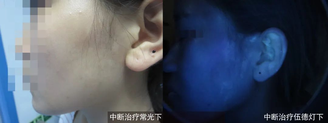 为什么别人的白癜风已经治好,而你的白癜风还一直在“陪伴”! 为什么别人的白癜风已经治好,而你的白癜风还一直在“陪伴”!