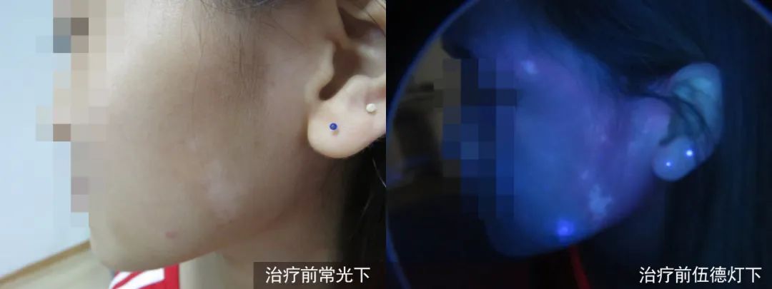 为什么别人的白癜风已经治好,而你的白癜风还一直在“陪伴”! 为什么别人的白癜风已经治好,而你的白癜风还一直在“陪伴”!