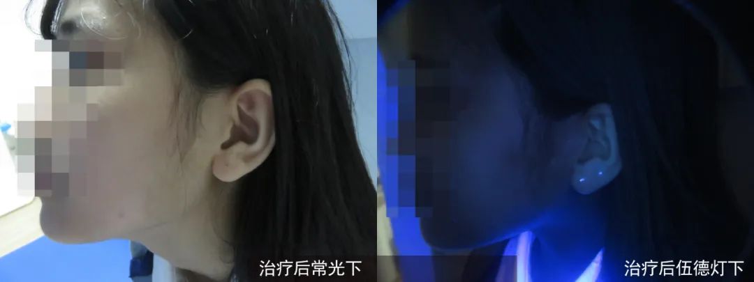 为什么别人的白癜风已经治好,而你的白癜风还一直在“陪伴”! 为什么别人的白癜风已经治好,而你的白癜风还一直在“陪伴”!