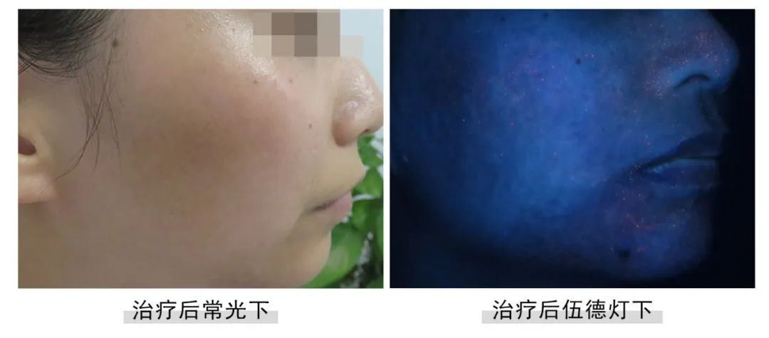 [七夕告白特辑]福建白癜风患者面部白斑终于没了,爱情不请自来！