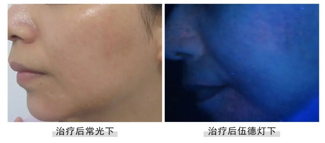 [七夕告白特辑]福建白癜风患者面部白斑终于没了,爱情不请自来！