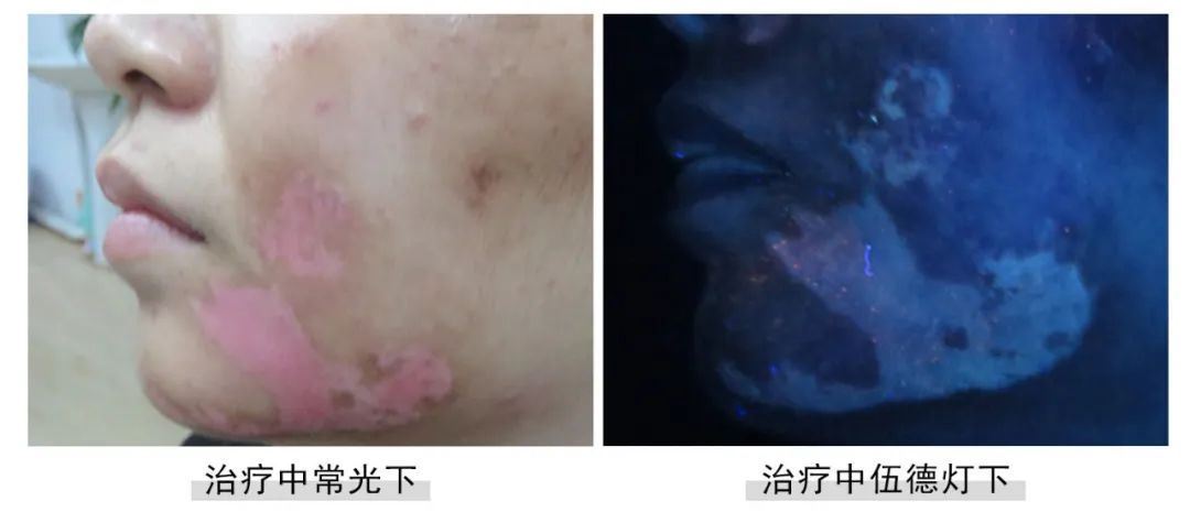 [七夕告白特辑]福建白癜风患者面部白斑终于没了,爱情不请自来！