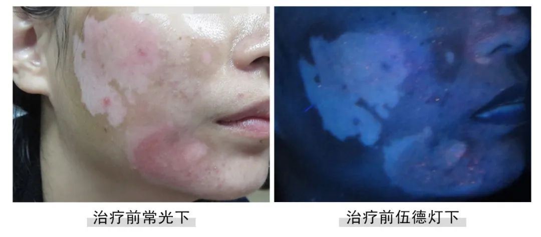 [七夕告白特辑]福建白癜风患者面部白斑终于没了,爱情不请自来！