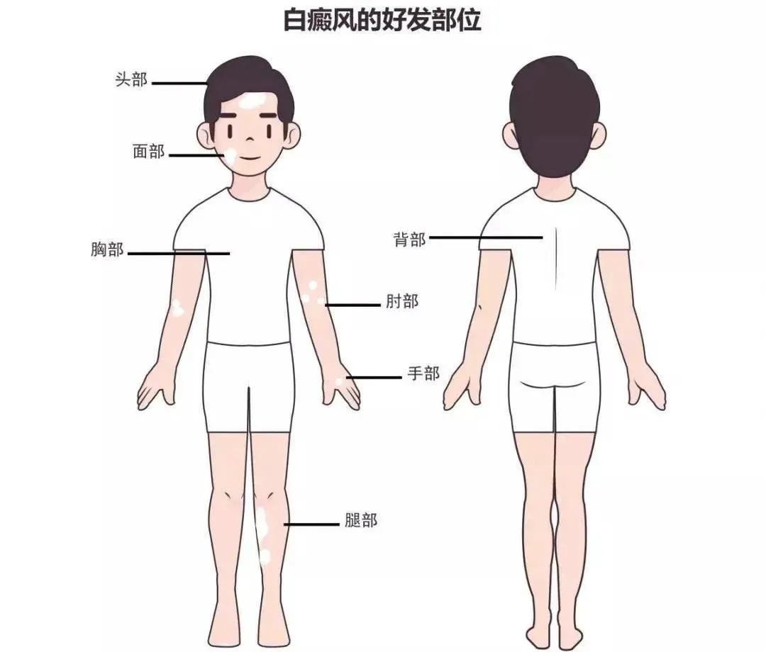 白癜风科普,皮肤出现这些症状不能忽视!福建哪家医院治疗白癜风比较好 白癜风科普,皮肤出现这些症状不能忽视!福建哪家医院治疗白癜风比较好