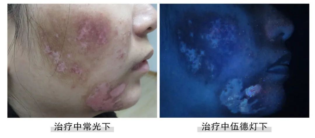 [七夕告白特辑]福建白癜风患者面部白斑终于没了,爱情不请自来！