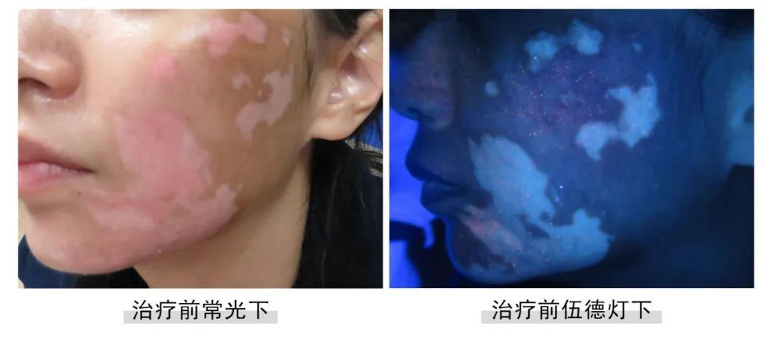 [七夕告白特辑]福建白癜风患者面部白斑终于没了,爱情不请自来！