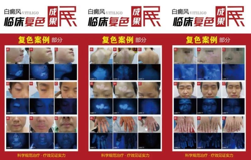 国庆黄金周·京闽白癜风大咖专家团会诊重磅来袭,名额有限!请速约! 国庆黄金周·京闽白癜风大咖专家团会诊重磅来袭,名额有限!请速约!