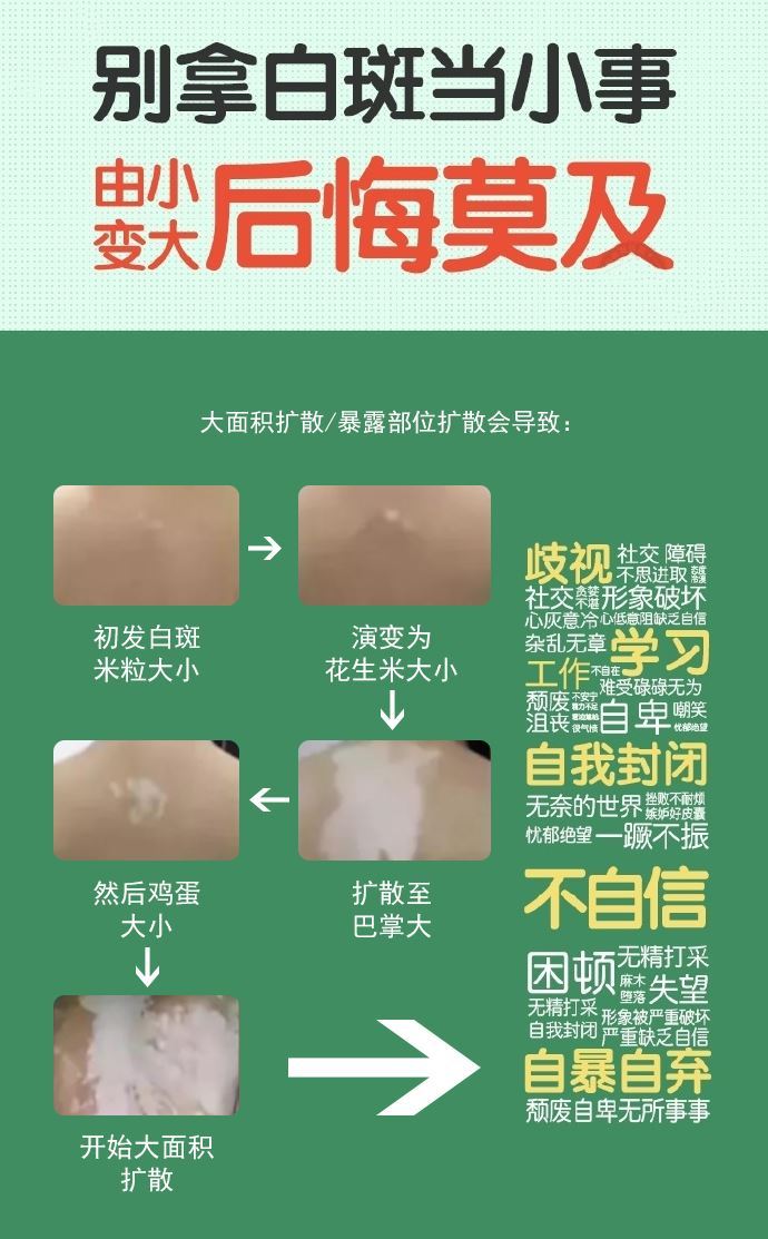 泉州治疗白癜风比较专业的医院，这种白斑肉眼不可见！