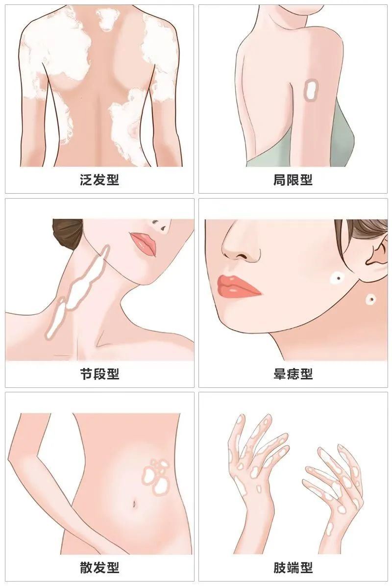 福建省治疗白癜风知名医生,白癜风究竟有多恐怖? 福建省治疗白癜风知名医生,白癜风究竟有多恐怖?