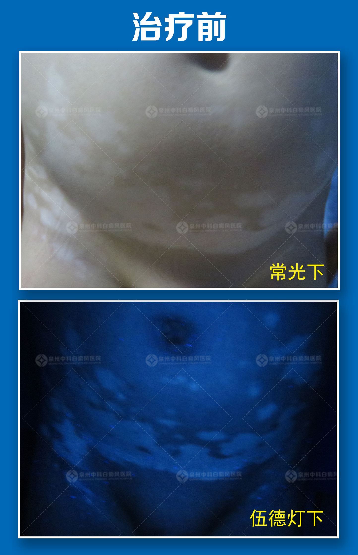 福建治疗白癜风比较专业的医院,这种白斑肉眼不可见! 福建治疗白癜风比较专业的医院,这种白斑肉眼不可见!