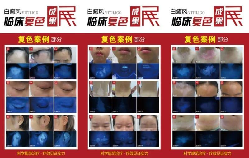 国庆黄金周·京闽白癜风大咖专家团会诊重磅来袭,名额有限!请速约! 国庆黄金周·京闽白癜风大咖专家团会诊重磅来袭,名额有限!请速约!