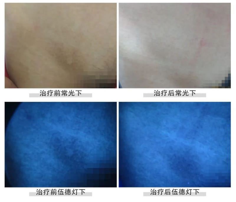 【锦旗案例】祛白多年仍无果,慕名来泉治白癜风,成功收获了健康! 【锦旗案例】祛白多年仍无果,慕名来泉治白癜风,成功收获了健康!
