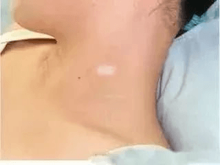 白癜风几个时期对应措施不同! 白癜风几个时期对应措施不同!