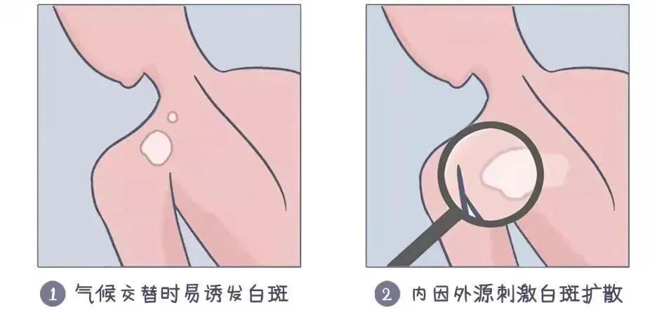 秋季打假!白癜风秋季“稳而不发”?拆穿白癜风“自愈”假象! 秋季打假!白癜风秋季“稳而不发”?拆穿白癜风“自愈”假象!