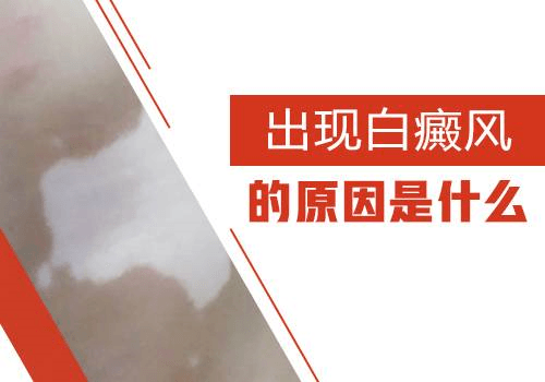 “做四休三”奇葩辞职背后的焦虑与白癜风