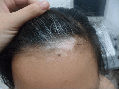 白癜风患者毛发变白是什么原因? 白癜风患者毛发变白是什么原因?