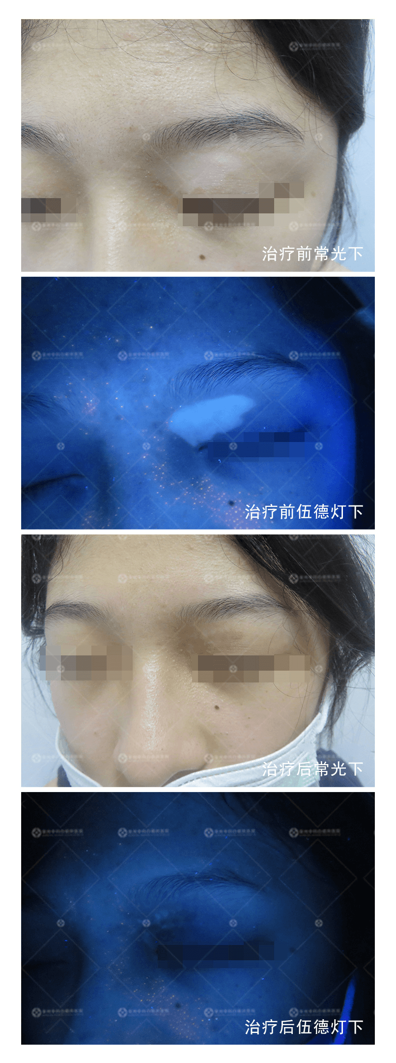 女大学生患上白癜风,病因竟是它…… 女大学生患上白癜风,病因竟是它……