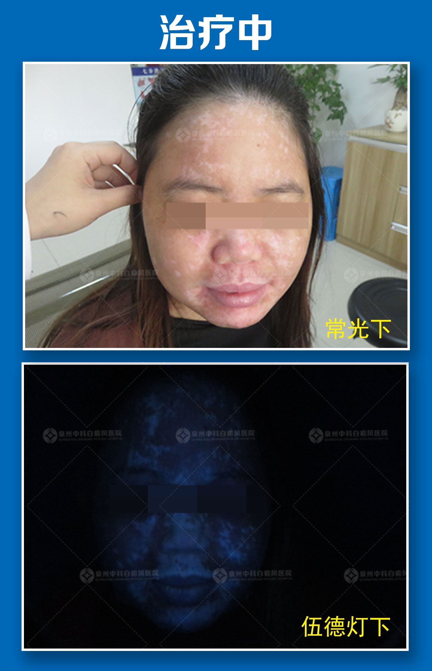 这些困扰女性白癜风患者的问题,有答案了 这些困扰女性白癜风患者的问题,有答案了