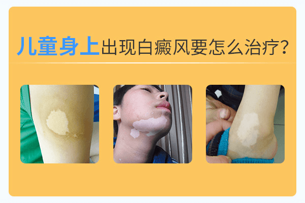 儿童患了白癜风要怎么护理? 儿童患了白癜风要怎么护理?