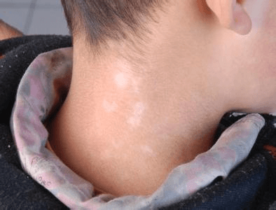 青少年白癜风患者到底怎么疏导心理? 青少年白癜风患者到底怎么疏导心理?