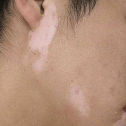 男性白癜风该怎么做护理 男性白癜风该怎么做护理