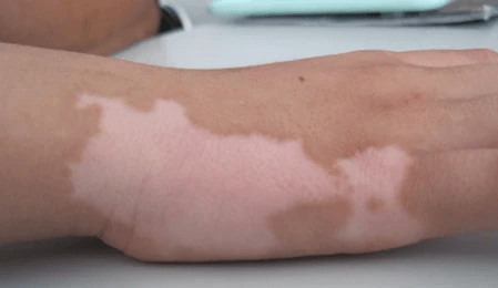 白癜风治好康复可能性高吗? 白癜风治好康复可能性高吗?