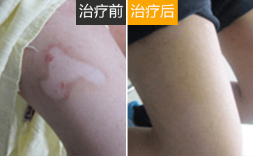 如何治疗腿部白癜风? 如何治疗腿部白癜风?