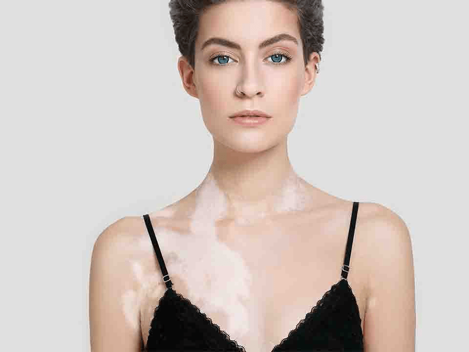女性患有白癜风后该如何调整? 女性患有白癜风后该如何调整?