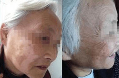 老年白斑常见的预防措施有哪些? 老年白斑常见的预防措施有哪些?