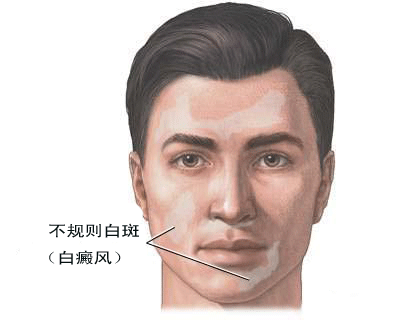 预防男性白癜风需要注意的问题有哪些? 预防男性白癜风需要注意的问题有哪些?