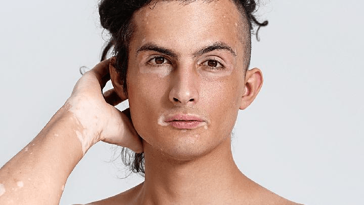 男性白癜风患者如何调节心理? 男性白癜风患者如何调节心理?