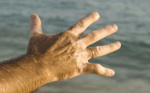 手部白癜风患者日常该怎么护理？
