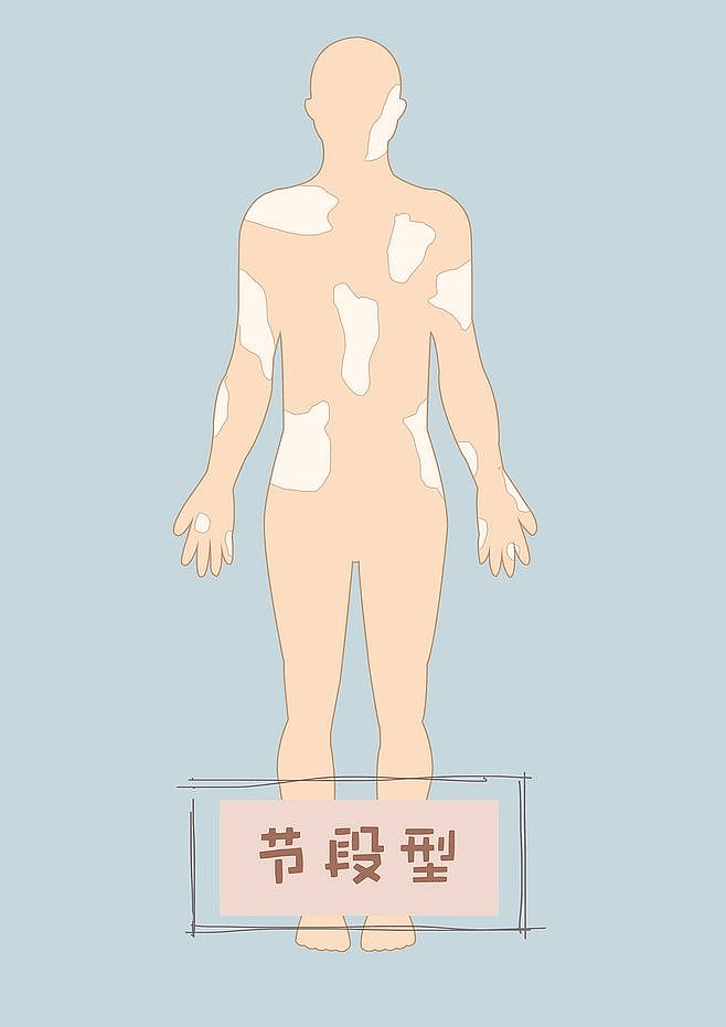 节段型白癜风怎样预防呢? 节段型白癜风怎样预防呢?