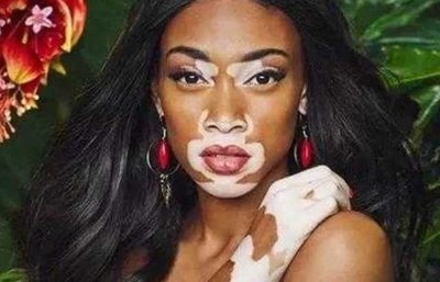女性患者在饮食方面有需要注意吗 女性患者在饮食方面有需要注意吗