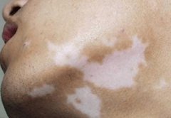 男性患白癜风后该怎么做好日常护理? 男性患白癜风后该怎么做好日常护理?