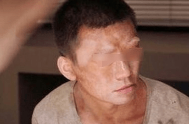 男性白癜风患者病发有什么症状呢? 男性白癜风患者病发有什么症状呢?