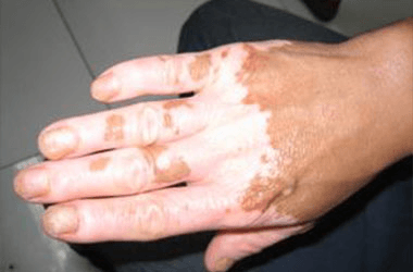 男性手部白癜风应该怎么去治疗? 男性手部白癜风应该怎么去治疗?