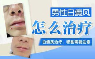男性出现白癜风发病都有哪些特点 男性出现白癜风发病都有哪些特点