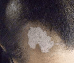 预防男性白癜风需要注意的问题有哪几点 预防男性白癜风需要注意的问题有哪几点