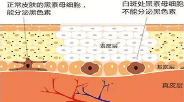 中老年人患白癜风的原因是什么