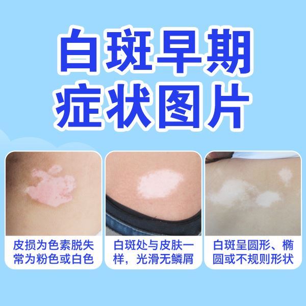 泉州白癜风医院哪家可信,那个位置白癜风易生长 泉州白癜风医院哪家可信,那个位置白癜风易生长