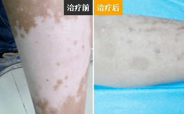 泉州白癜风医院官网,怎么知道腿部白斑是不是白癜风呢? 泉州白癜风医院官网,怎么知道腿部白斑是不是白癜风呢?
