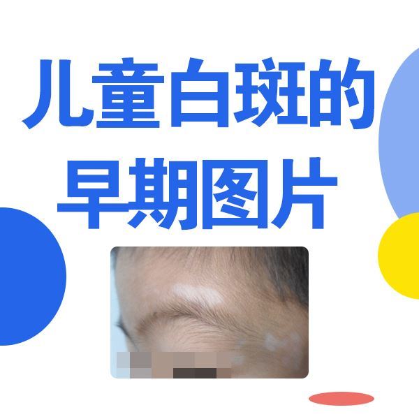 福建泉州治疗白癜风的医院,儿童白癜风护理注意什么 福建泉州治疗白癜风的医院,儿童白癜风护理注意什么