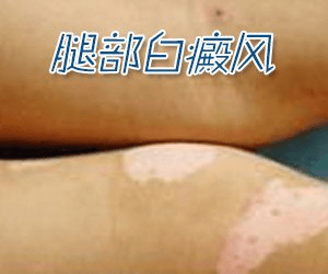 白癜风长在腿上注意哪些呢? 白癜风长在腿上注意哪些呢?