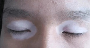 眼周白癜风会加重孩子近视吗？