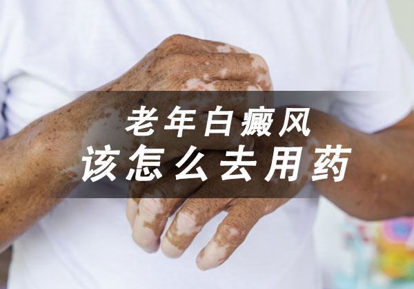 老人白癜风治疗该怎样用药呢? 老人白癜风治疗该怎样用药呢?